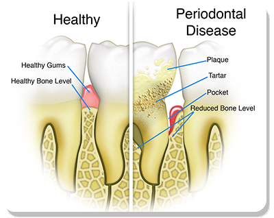 Periodontal Disease Treatment Bradenton